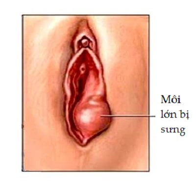 Môi lớn bị sưng